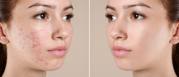 Treatment For Acne In Chester & Hackettstown, NJ